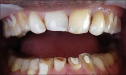 Teeth damaged by bruxism