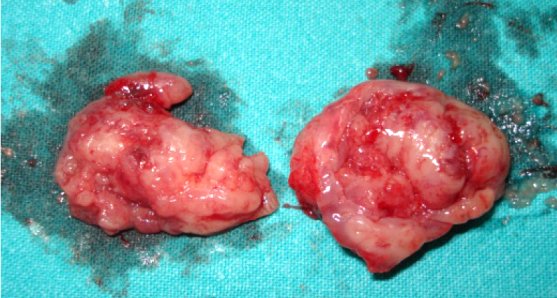 tonsils regrowing
