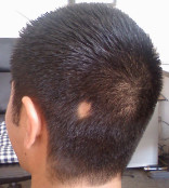 Example of an alopecia-effected individual