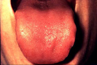 Burning mouth syndrome