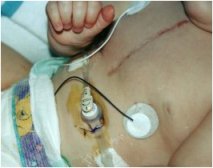 Feeding tube into infant